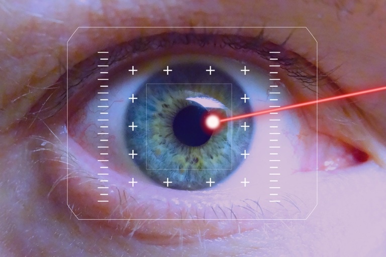 Laser Cataract
