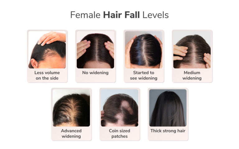 Traya's Study Reveals a Concerning Finding: One in Two Women Aged 36-40 Suffer from Advanced Widening or Female Pattern Hair Loss